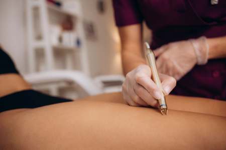 Spider Vein Removal and Treatment for Healthy Circulation